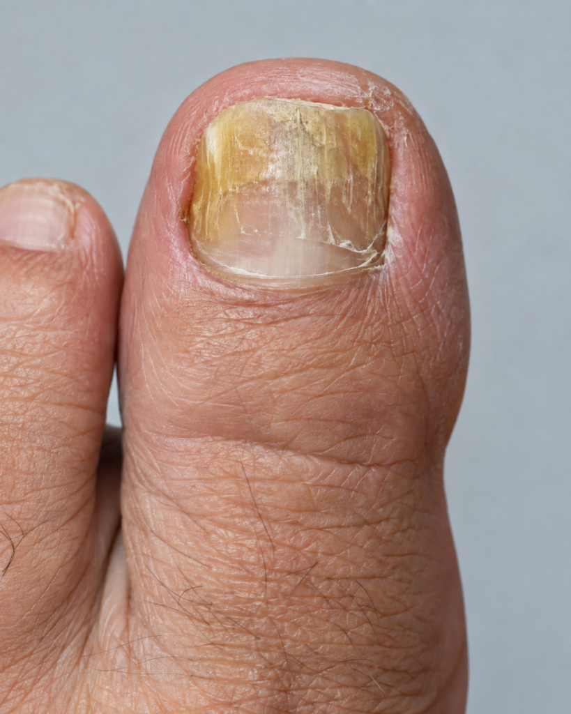 Close-up of a thickened discoloured toenail requiring podiatry assessment